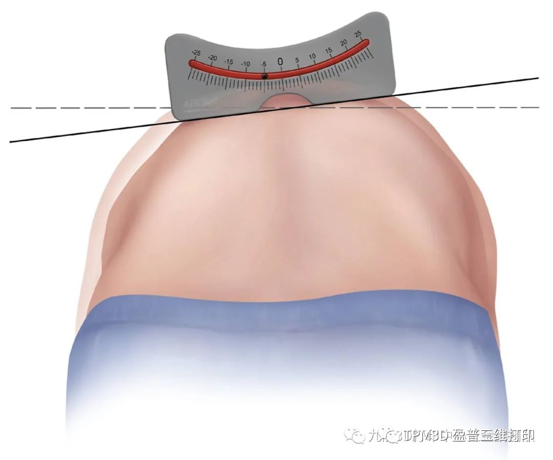 脊柱側彎檢測